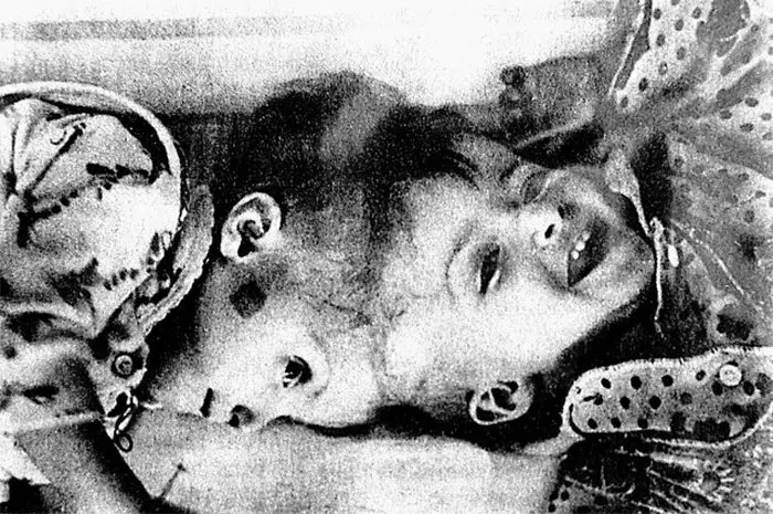 Две жизни, одна голова: Как советские врачи подарили сестрам Тамулявичюте право на отдельную судьбу