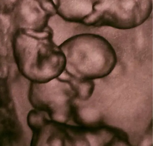 Чудо в роддоме: в Петербурге родились четыре идентичные девочки