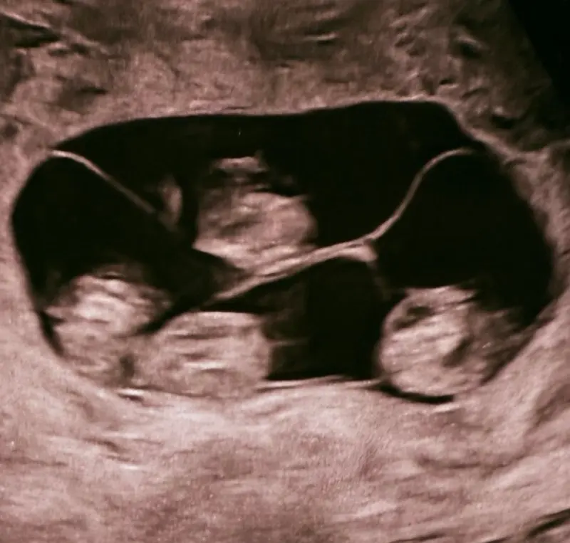 Чудо в роддоме: в Петербурге родились четыре идентичные девочки