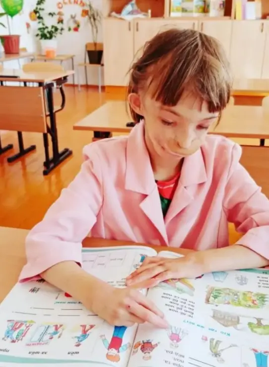 Девочка без подбородка: как сложилась судьба Дарины Шпенглер спустя 12 лет