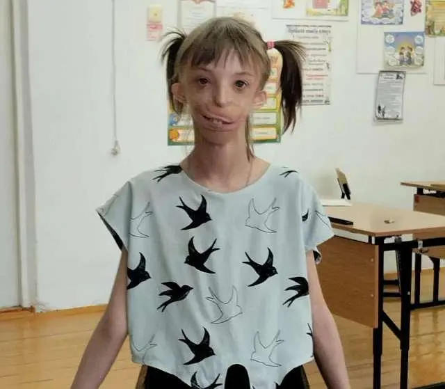 Девочка без подбородка: как сложилась судьба Дарины Шпенглер спустя 12 лет