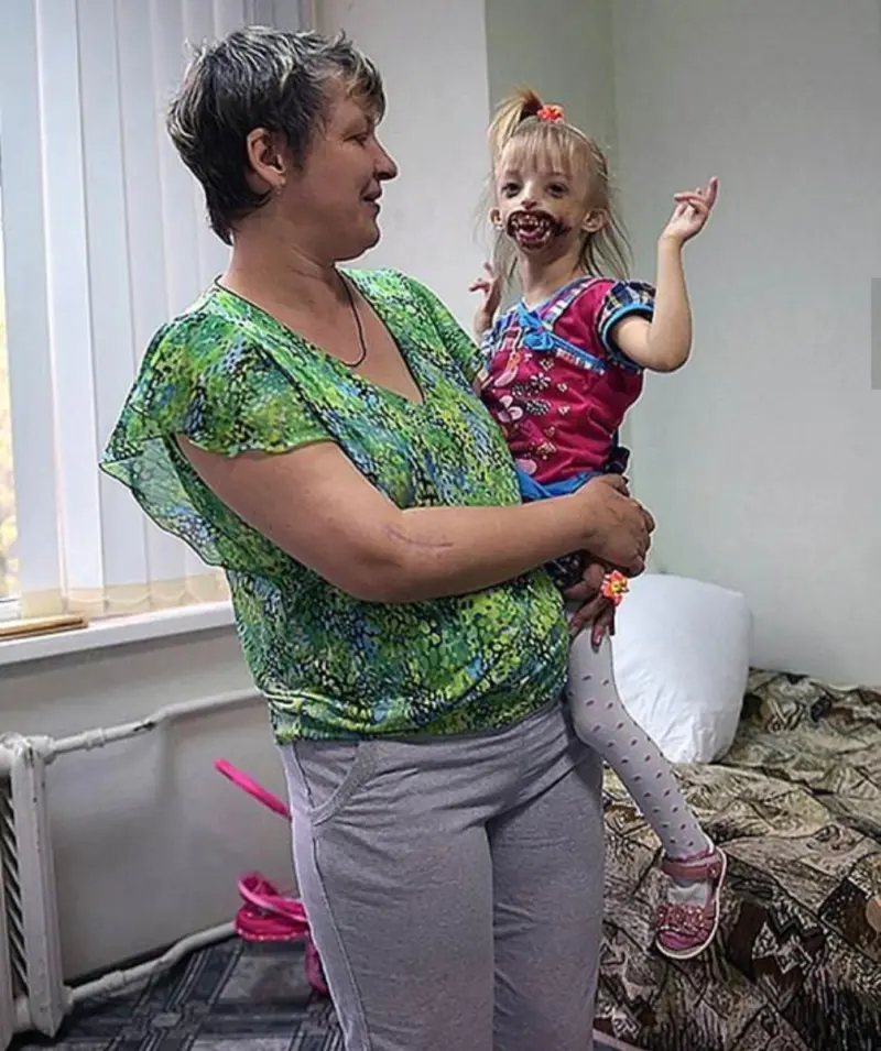 Девочка без подбородка: как сложилась судьба Дарины Шпенглер спустя 12 лет