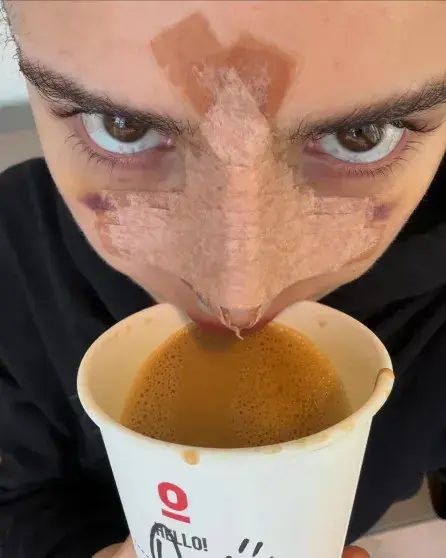 Дина Саева показала нос после операции и снова заявила: «Не ради эстетики»