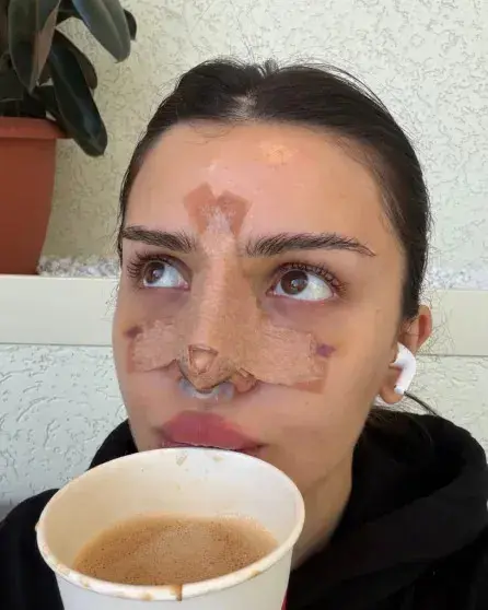 Дина Саева показала нос после операции и снова заявила: «Не ради эстетики»