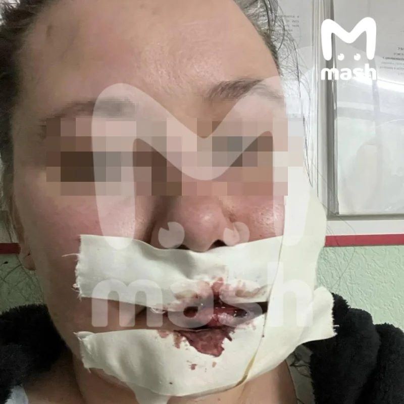Шрам на пол-лица за 250 рублей: история пациентки скорой из Уфы Уфа, ДТП, скорая помощь, страховая компания, несправедливость, шрам, компенсация, ВСК